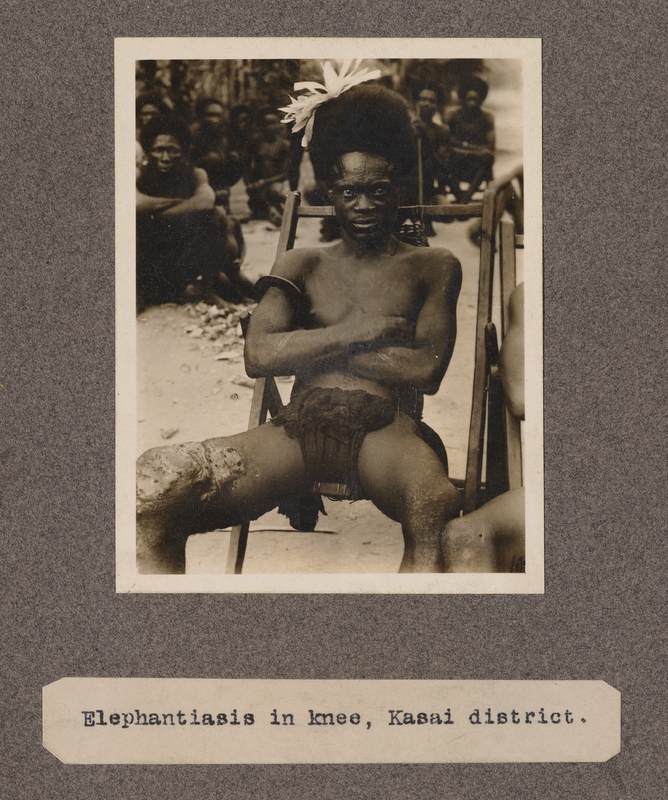 Elephantiasis in knee, Kasai District