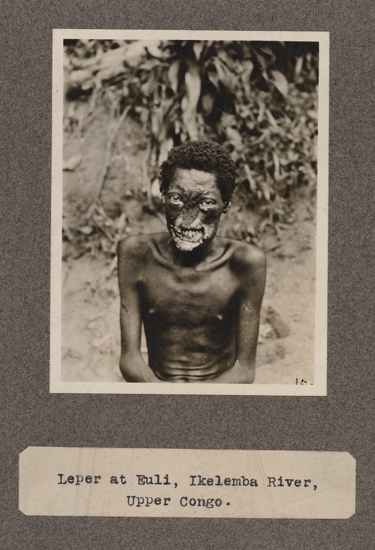 Leper at Euli, Ikelemba River, upper Congo