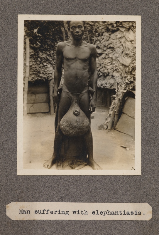 Man suffering with elephantiasis