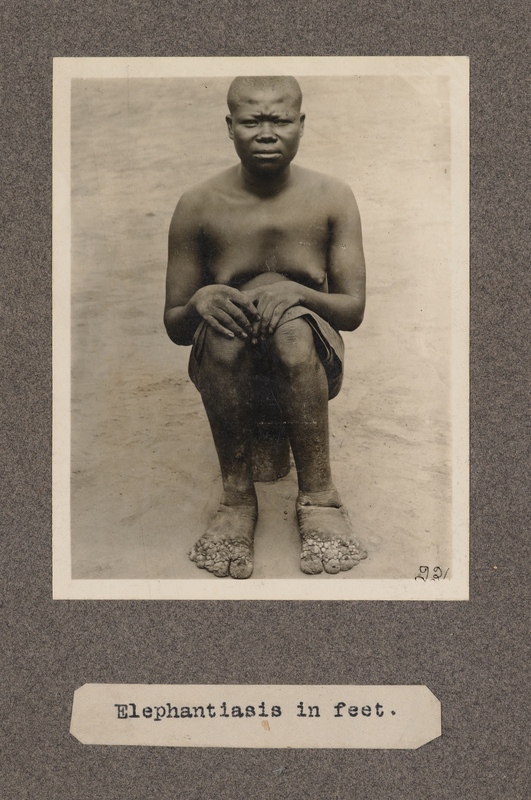 Elephantiasis in feet